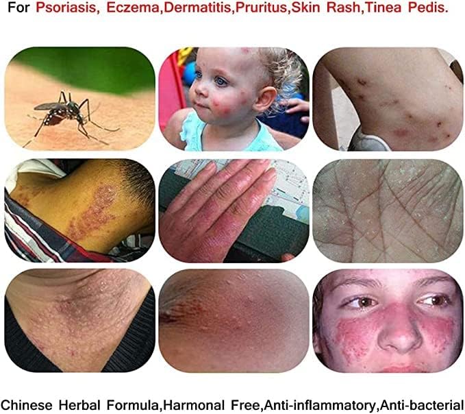 Goreem Skin Care Chinese Herbal Cream Bacteriostatic cream Rich in Herb Extract Essence Product Relief Pruritus Eczema Creams Dermatitis Psoriasis Ointment Skin Treatment Products - Image 5