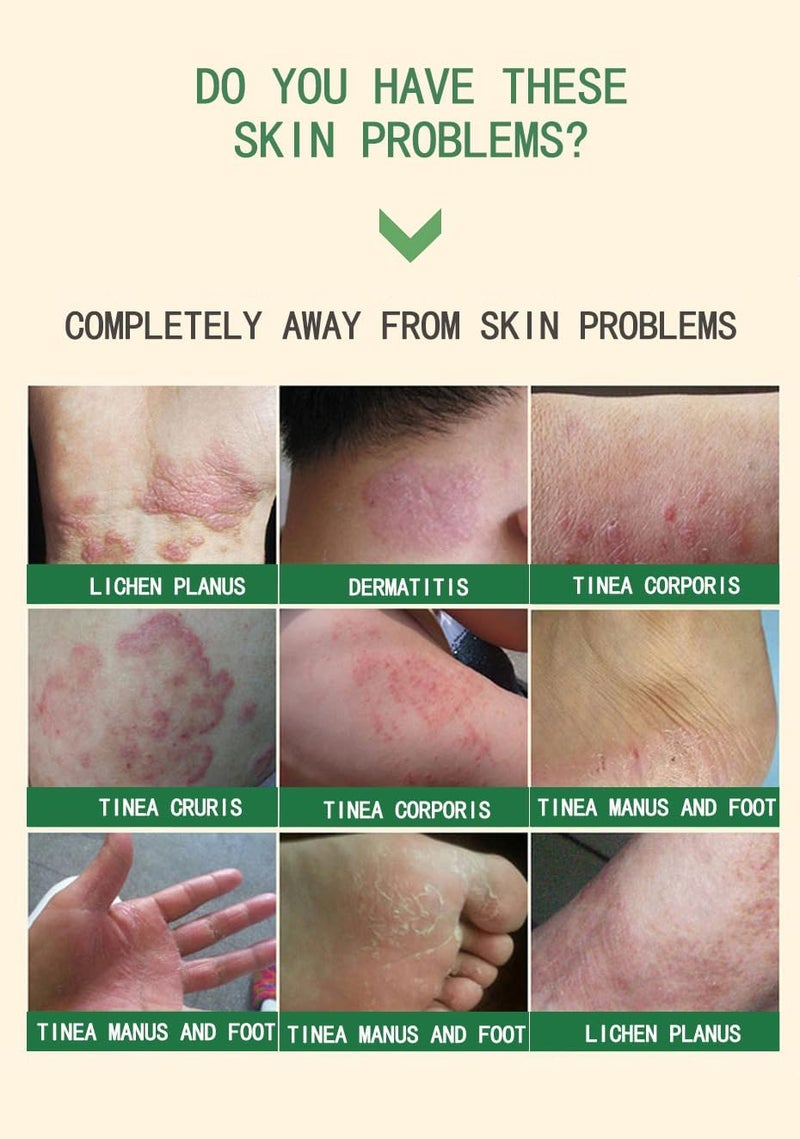 Goreem Skin Care Chinese Herbal Cream Bacteriostatic cream Rich in Herb Extract Essence Product Relief Pruritus Eczema Creams Dermatitis Psoriasis Ointment Skin Treatment Products - Image 2