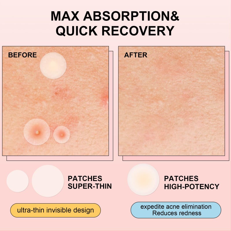 AVJONE Pimple Patches for Face(144 Patches), Hydrocolloid Acne Patches with Tea Tree Oil, pimple stickers for Breakouts, Absorbs Zit, Invisible Spot Cover and Blemish - Image 3