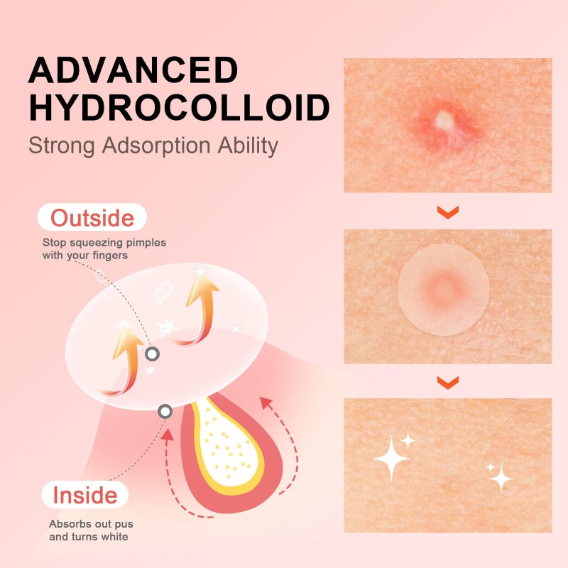 AVJONE Pimple Patches for Face(144 Patches), Hydrocolloid Acne Patches with Tea Tree Oil, pimple stickers for Breakouts, Absorbs Zit, Invisible Spot Cover and Blemish - Image 2