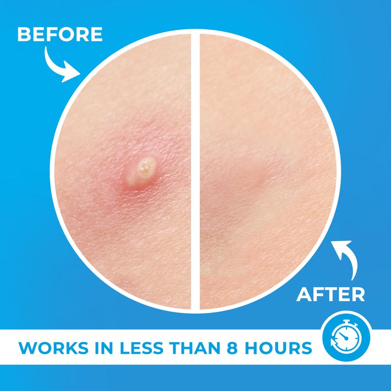 KEYCONCEPTS PatchRx Pimple Patches for Face (500 Patches), Hydrocolloid Acne Patches with Tea Tree Oil, Pimple Patch Pimple Stickers - Hydrocolloid Patch Acne Dots - Acne Pimple Patches For Face - Zit Patches - Image 3