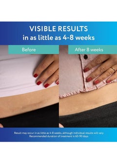 سكار أواي شرائح سيليكون شفافة لعلاج الندبات من سكار أواي، بيضاء، 6 قطع  - Image 4
