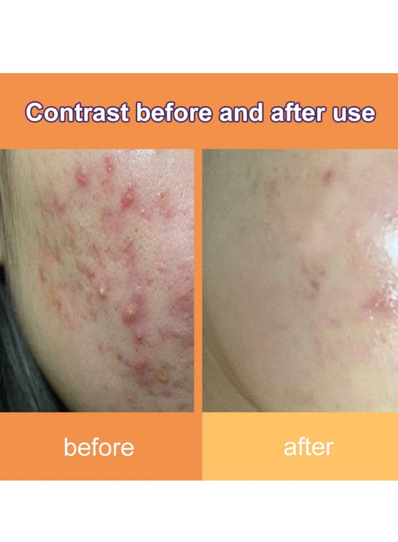 DERMFREE Adapalene Gel Acne Treatment Acne Treatment Cream Acne Treatment Ointment Gel Acne Relief Cream Gentle Moisturizing Acne Removing Gel Pimple and Acne Removal Anti Acne Gel 20g - Image 4