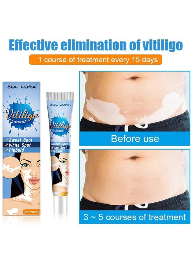 SOL LORA Vitiligo Ointment, Vitiligo Treatment For Skin Vitiligo, Vitiligo Care Cream For Reduce White Spots And Improve Skin Pigmentation 20G - Image 5