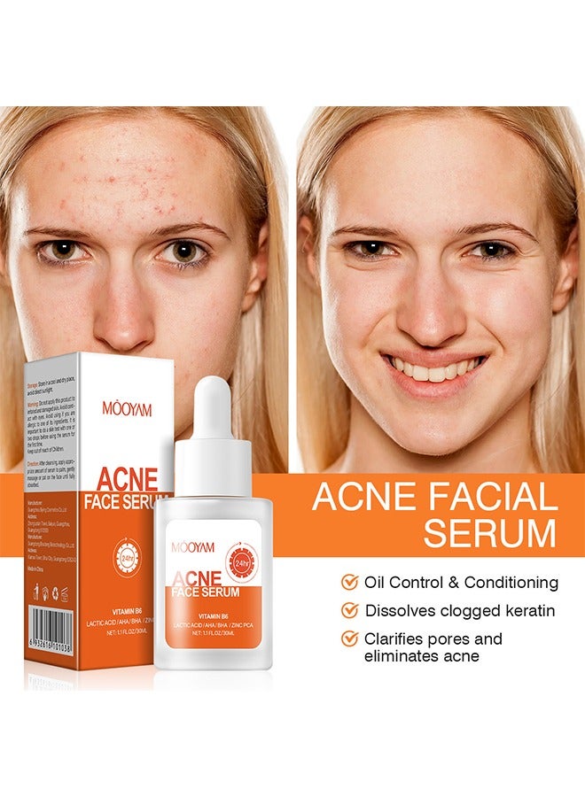 MOOYAM Acne Face Serum-Salicylic Acid Acne Repair Serum,Salicylic Acid Oil Control Acne Treatment Essence, Anti-Acne Exfoliating Gentle Salicylic Acid Serum, Promote the Renewal of Epidermal Cells, Delicate Skin 30ML  - Image 2