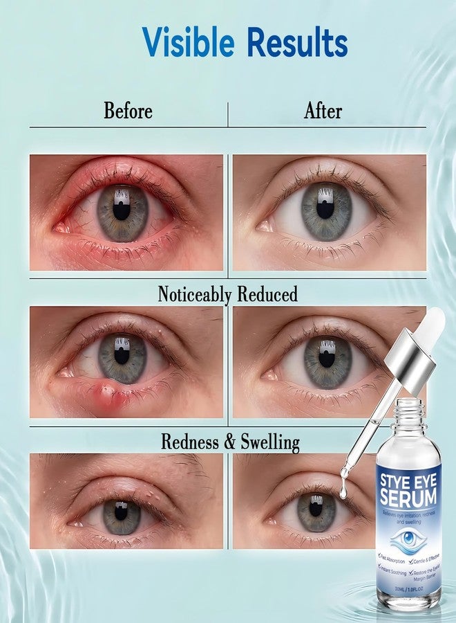 Nexkayee Stye Eye Treatment Serum for Irritation Relief, Soothing Formula for Stye and Chalazion Care, Gentle Daily Use Eye Serum, Helps Reduce Redness and Puffiness, Easy Dropper Application, 30ML - Image 3