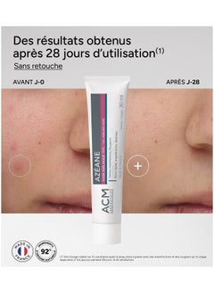ACM Laboratoire dermatologique Azéane Azelaic Acid Cream 15% – Fades Dark Spots, Reduces Redness & Blemishes, Brightens & Smooths Skin (2-Pack)  - Image 2