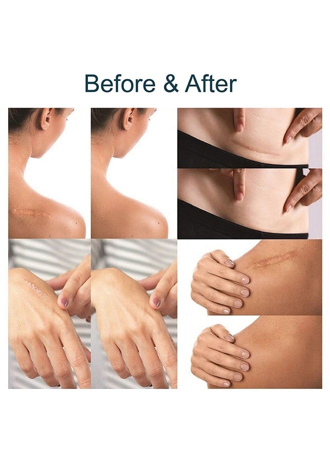 Horse Silicone Scar Sheets - As Surgical Cream, Gel, Tape, Strips, Patches - Keloid, C-Section, Tummy Tuck - Surgery Scars Removal Treatment (10 Pack, 4cmx15cm)  - Image 4