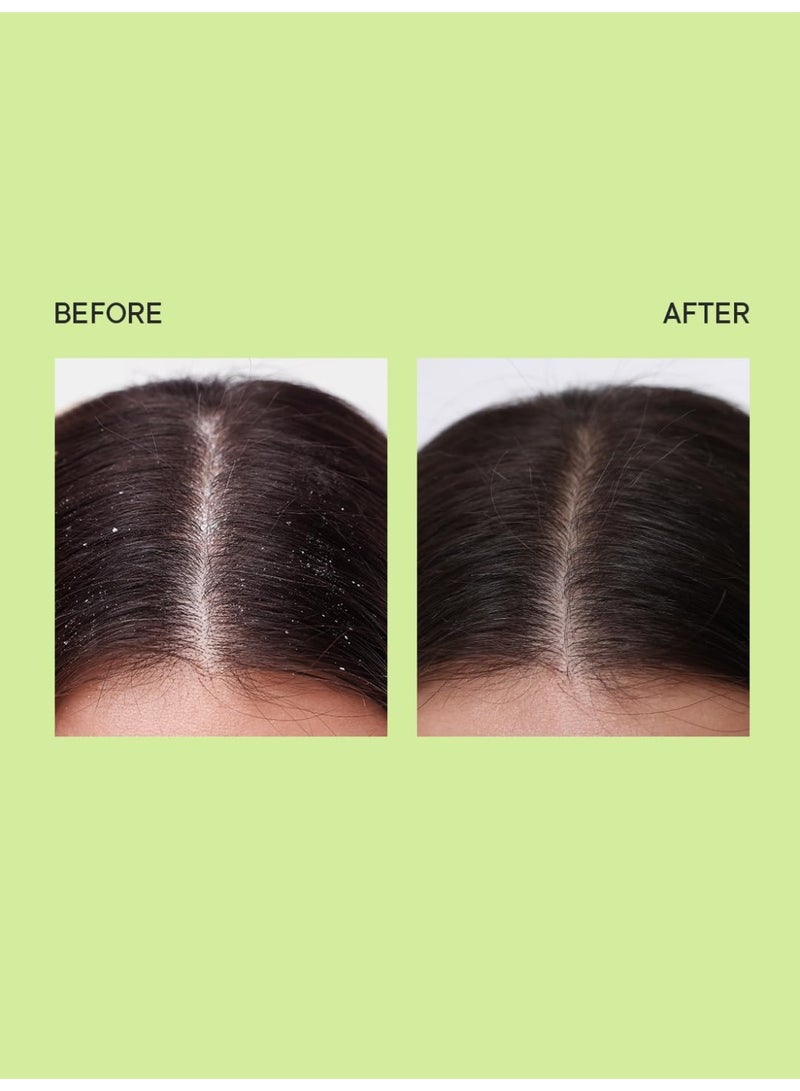 كوينش سيروم الشعر للتحكم في القشرة مع مستخلصات شجرة الشاي | يعالج القشرة والرقائق وفروة الرأس الدهنية | يقوي ويرطب بعمق | صنع في كوريا (100 مل) - Image 4