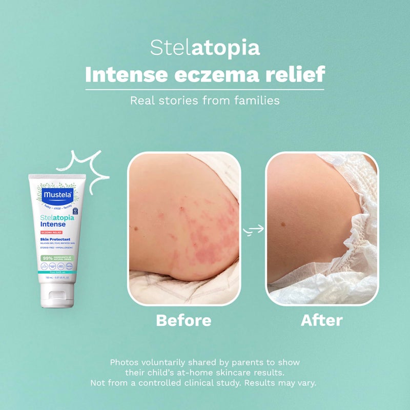 Mustela Eczema Relief Cream Stelatopia Intense - Fragrance-Free Moisturizing Body Lotion with Colloidal Oatmeal - For dry, itchy, irritated skin & flare-ups - Baby, Child & Adult - 5.07 fl. oz. - Image 4