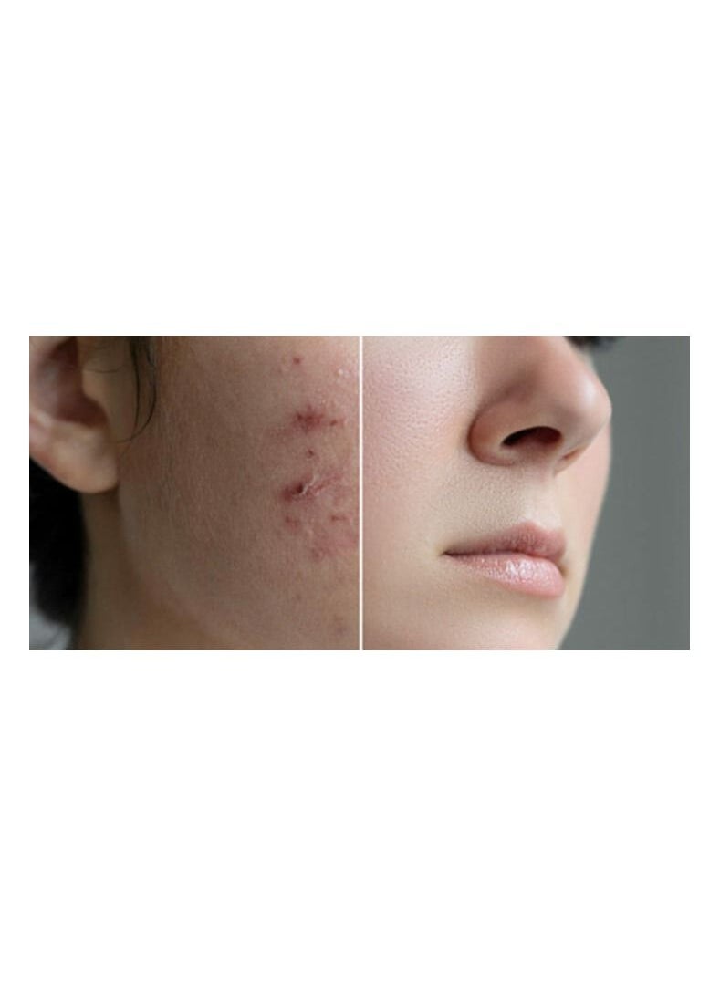 JAMJOOM PHARMA - Akertin 0.05% Acne Treatment Cream 30 g - Image 1