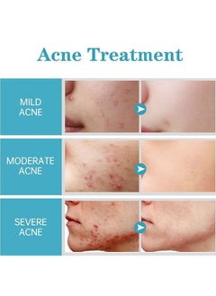 AuQuest Salicylic Acid Acne Face Cream Whitening Facial Treatment Hyaluronic Acid Black Dots Remove Skin Care Beauty Health Repairing Skin Base Essence 15ml  - Image 5