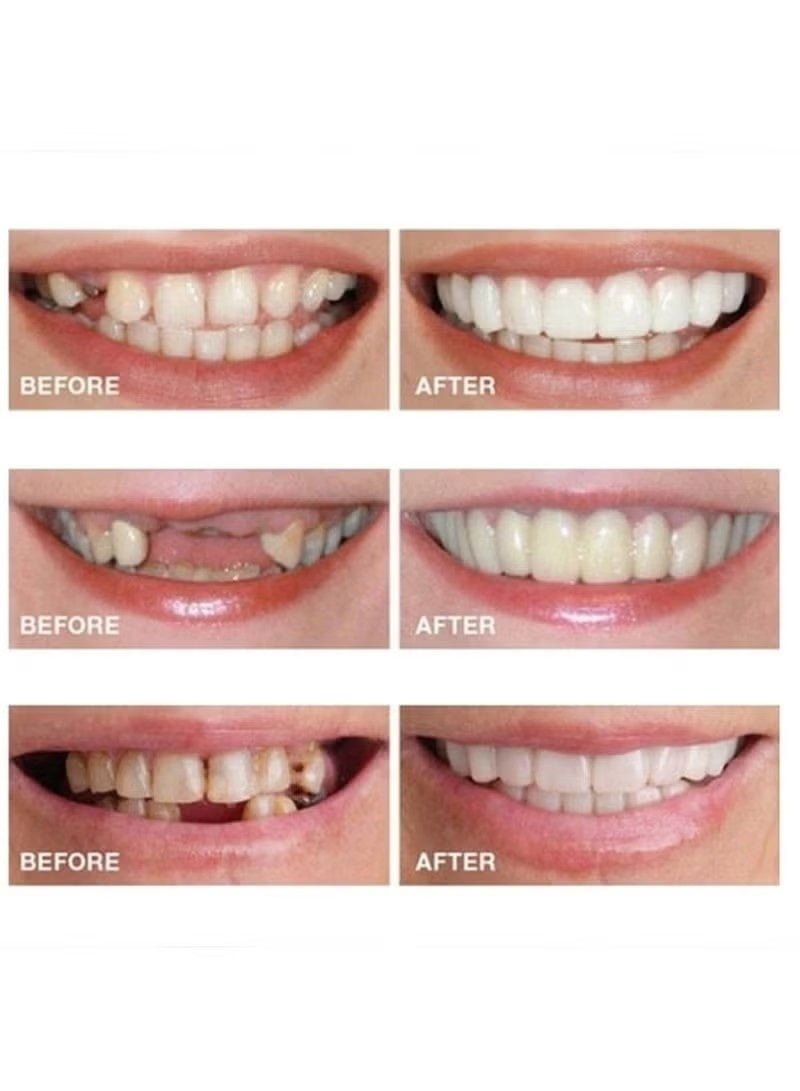 NH Generic Snap-On Smile Veneers | Removable Teeth Covers for Whitening & Alignment | Alternative to Braces | For Men & Women - Image 4