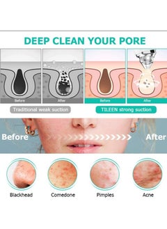 OASIS-TH Black Head Pimple Vacume Removal with camera  Pore Vacuum Cleaner Blackhead Suction Tool, 20X Microscope Camera Rechargeable Facial Comedone Acne Extractor for Men Women  - Image 2