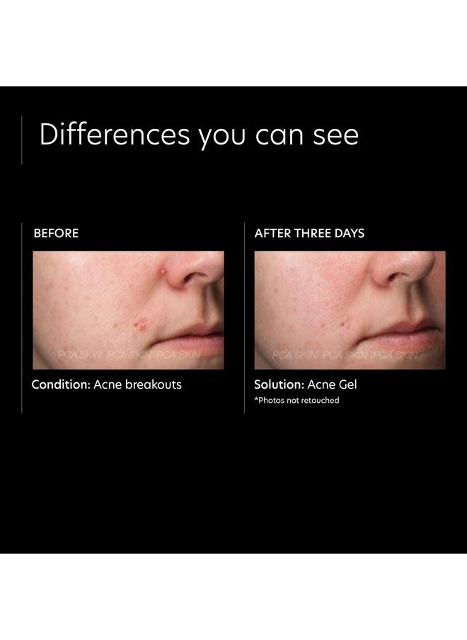 PCA SKIN PCA SKIN Acne Gel, Acne Spot Treatment, 2% Salicylic Acid Serum, Anti Acne Serum, Evens Skin Tone, 1 fl oz Pump  - Image 4