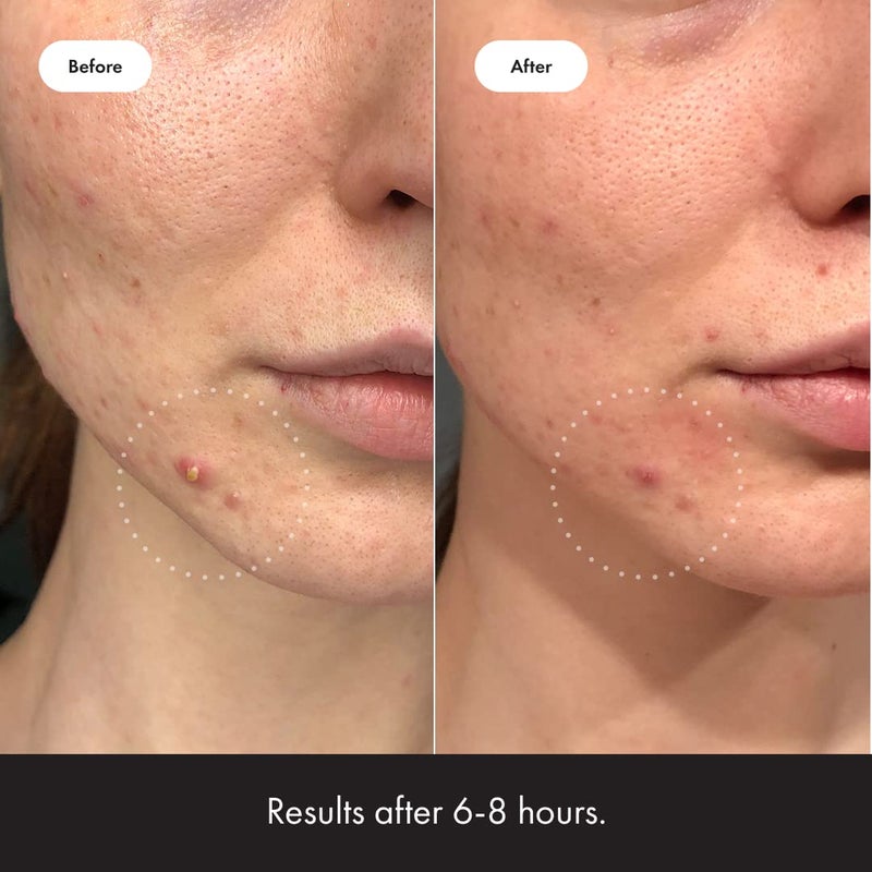 Mighty Patchâ„¢ Invisible+ Patch - Daytime Hydrocolloid Acne Pimple Patches for Covering Zits and Blemishes, Ultra Thin Spot Stickers for Face and Skin (24 Medium and 15 Small Patches) - Image 4