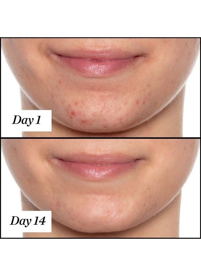 U.F.O. Ultra-Clarifying BHA Salicylic Acid and Tea Tree Acne Treatment Face Oil