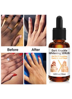 CARVENCHY Dark Knuckle Whitening Serum - Skin Whitening Oil Brightening Dark Spots,Obvious Useu Effect，Get Rid of Knuckles Easily In Just 7 Days，Whitening Knee Melanin with Glow Essence,30 ml  - Image 1