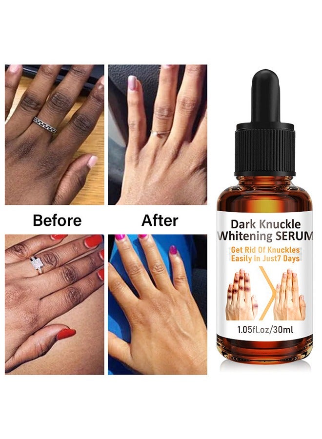 CARVENCHY Dark Knuckle Whitening Serum - Skin Whitening Oil Brightening Dark Spots,Obvious Useu Effect，Get Rid of Knuckles Easily In Just 7 Days，Whitening Knee Melanin with Glow Essence,30 ml - Image 1
