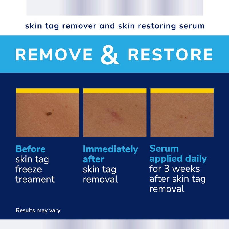 Dr. Scholl's Complete Care Skin TAG Remover, 12 Ct // Removes Skin Tags & Restores Skin's Appearance, FDA-Cleared, Clinically Proven, 12 Treatments Plus Hydrating Serum - Image 5