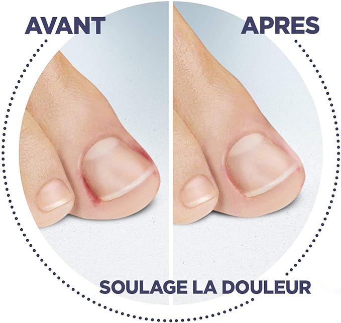 Scholl Ingrowing Toenails Treatment Kit Clip Spray Treating Ingrown Toenails Nail Care Nail Treatment - Image 2