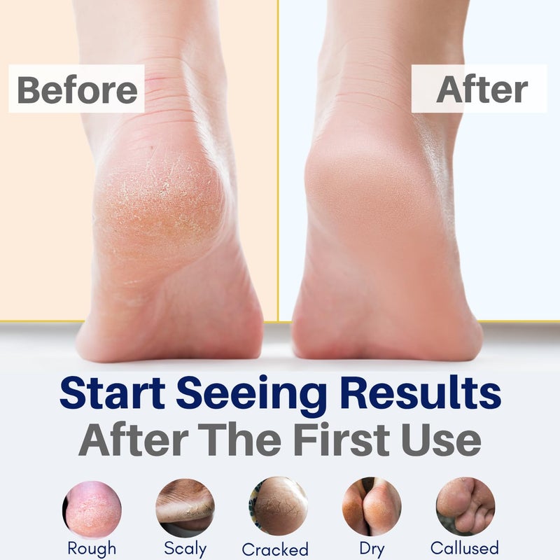 The Yellow Bird Yellow Bird Natural Tea Tree Foot Cream & Organic Foot Balm for Dry, Cracked Feet & Heels â€“ Peppermint Moisturizer for Athleteâ€™s Foot Relief and Intensive Callus Repair Treatment Salve â€“ Made in USA - Image 2