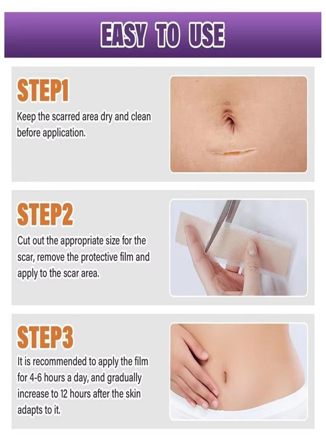 Bokor Silicone Scar Sheets, Silicone Scar Tape for Surgical Scars, Scar Removal Patches with Medical Grade Treatment (1.5M - Image 5