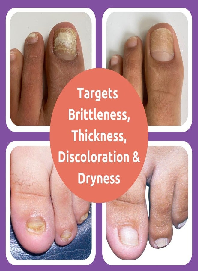 Dr. Blaine's VITÉ20 Nail Health Serum - Improves Nail Appearance for Discoloration, Thick, Brittle & Cracking Nails - Moisturizes & Conditions - Easy Brush-On Applicator for Fingernails & Toenails - 0.5 fl oz - Image 3