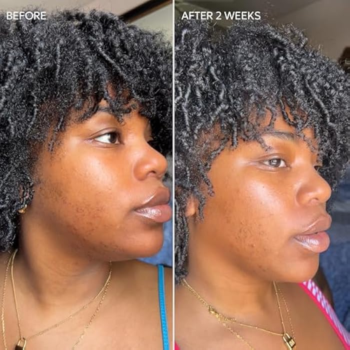 Dermisa Skin Fade Cream with Vitamin C | Helps Reduce Dark Spots and Age Spots | All Skin Types | 1.78 OZ | Pack of 1 - Image 4