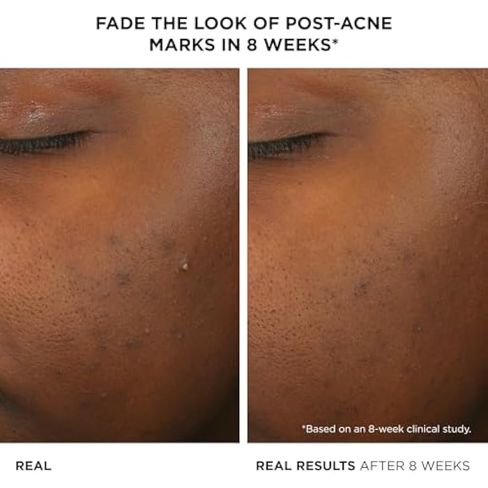 IT Cosmetics Bye Bye Breakout Acne Treatment Face Serum -With 2% Salicylic Acid & 3% Lactic Acid - Helps Reduce Pimples in 3 Days & Fades Look of Post-Acne Marks in 8 Weeks - 1 Fl. Oz - Image 2