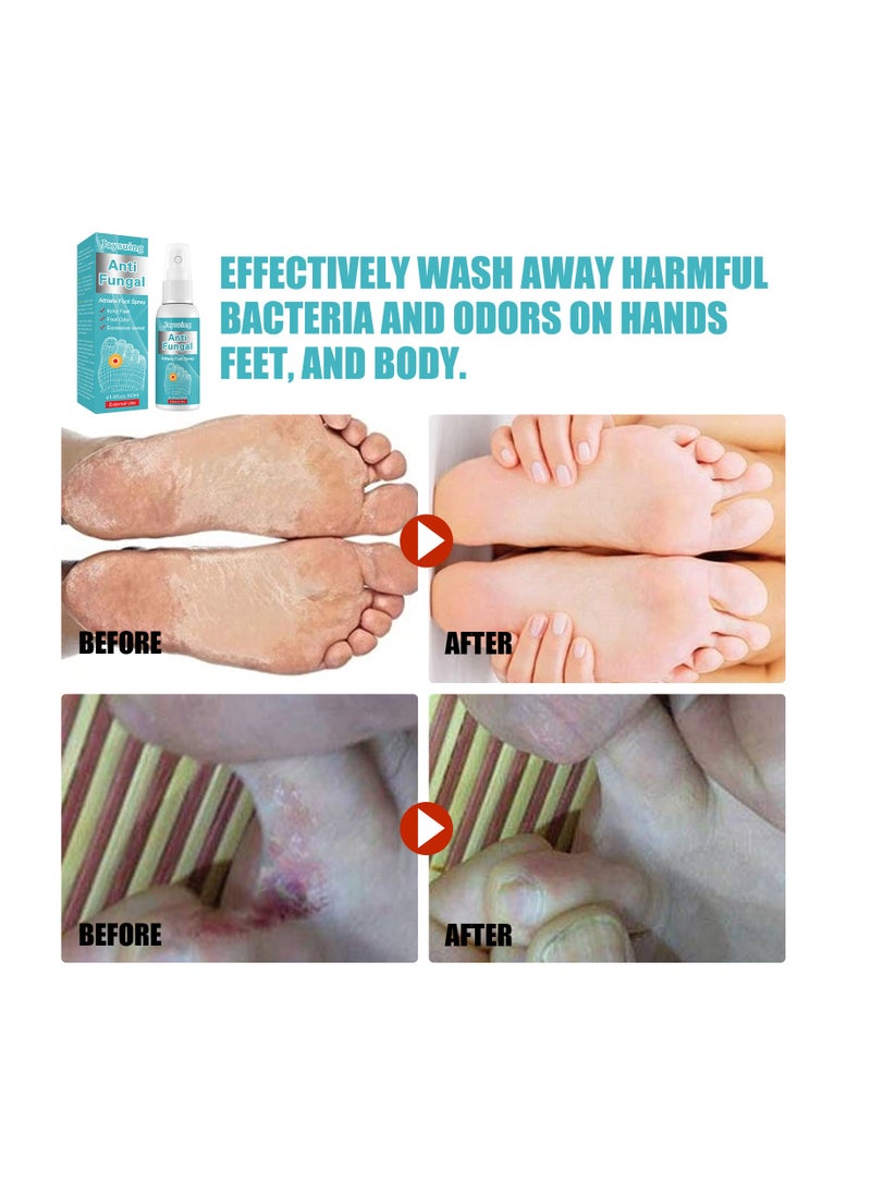 Jaysuing - Anti Fungal for Prevent Athlete's Foot,Smelly Feet,Relieve Itching of Feet - Image 1