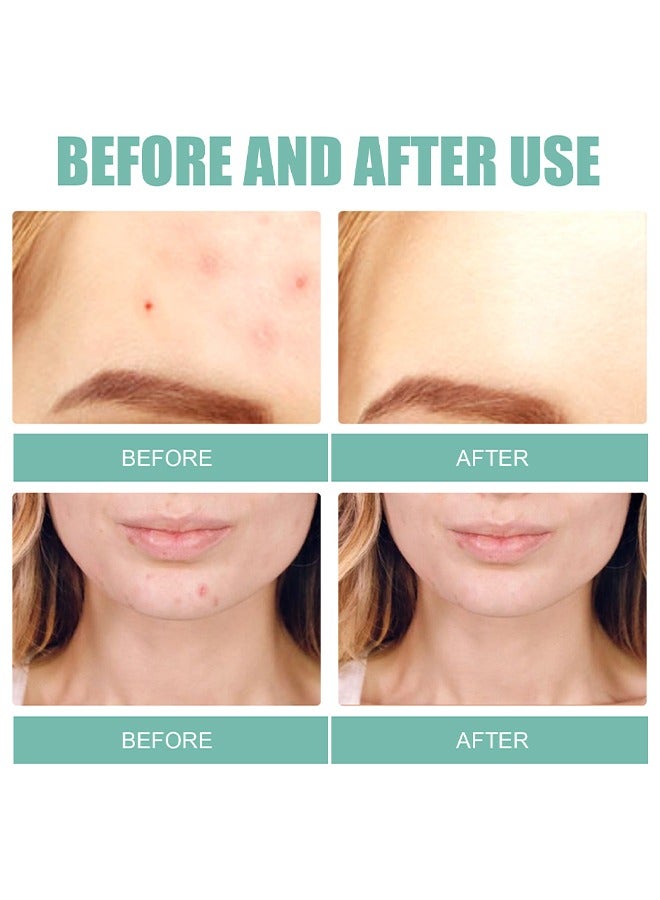 إيلهو بقع حب الشباب ، 5 أحجام 132 بقع بثرة للوجه أو الذقن أو الجسم ، علاج حب الشباب بشجرة الشاي وحمض الساليسيليك ، ضمادات غروانية مائية لبشرة حب الشباب - Image 5