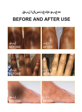 Yellow Peeling Oil 110ml Super Strength Dead Skin Remover Extra Strong Exfoliating Chemical Exfoliant Peeling Oil Skin Moisturizing Hydrating Butter Peeling Skin Whitening Peeling Solution for Dull Skin and Uneven Skin Tone for Body Hand Foot Knuckle All Skin Type - view 5