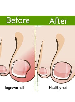 KASTWAVE Ingrown Toenail Corrector Strips Toenail Correction Patches Curved Toenails Straightening Recover Clips Thick Paronychia Pedicure Tool Toenail Straightener Strip for Men Women Foot Care 100 Pieces  - Image 5