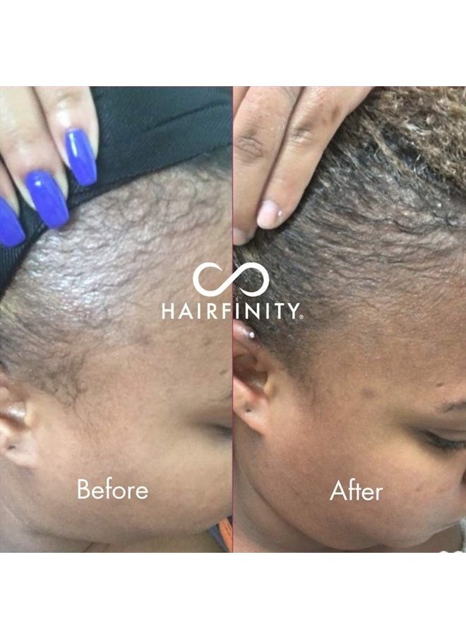 HAIRFINITY - Infinite Edges Hair Serum - Hair Growth Treatment to Prevent Hair Loss and Stimulate Hair Follicles to Stop Hair Loss and Regrow Hair - Targets Causes of Alopecia - Sulfate & Silicone Free - Image 1