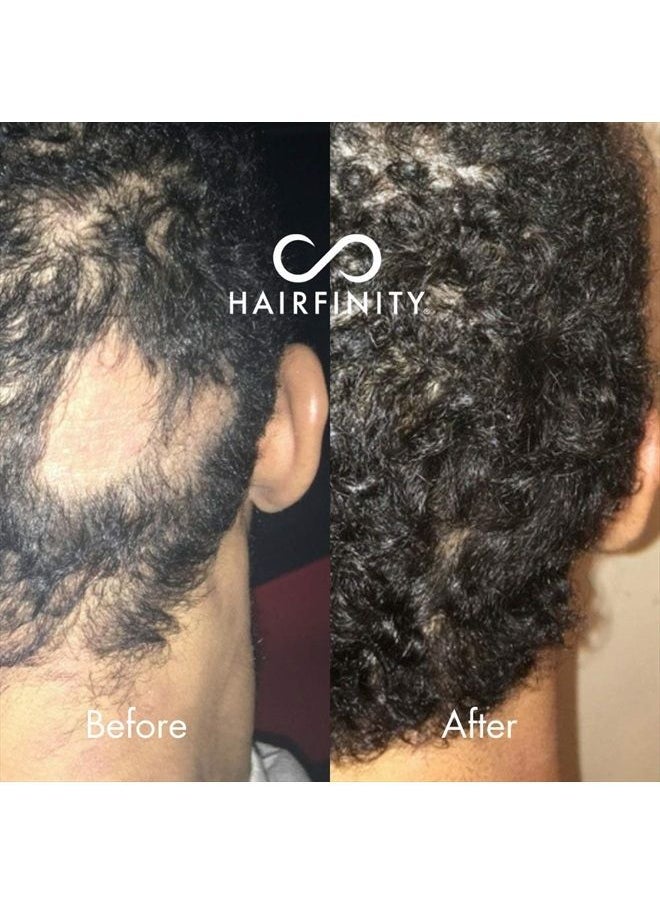 HAIRFINITY - Infinite Edges Hair Serum - Hair Growth Treatment to Prevent Hair Loss and Stimulate Hair Follicles to Stop Hair Loss and Regrow Hair - Targets Causes of Alopecia - Sulfate & Silicone Free - Image 1