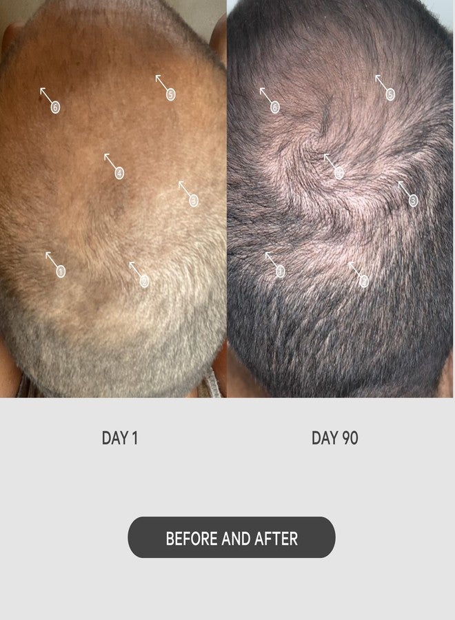 DS LABORATORIES نظام تحفيز الشعر بإبر دقيقة DS Labs StimuROLLER 0.25 مم، قد يختلف التعبئة - Image 3