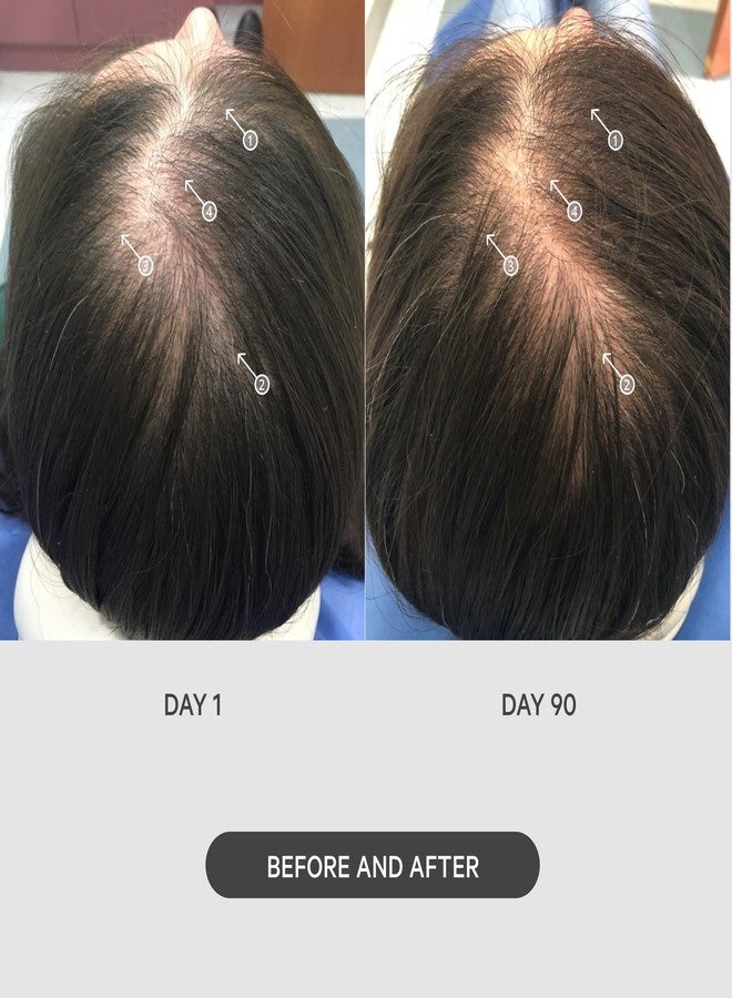 DS LABORATORIES نظام تحفيز الشعر بإبر دقيقة DS Labs StimuROLLER 0.25 مم، قد يختلف التعبئة - Image 4