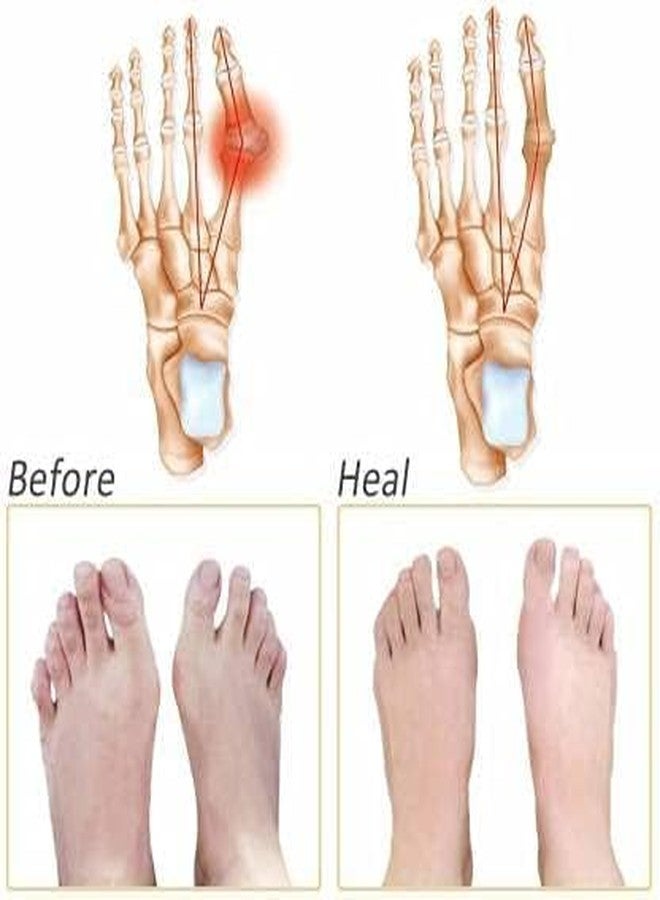 Generic Silicone Gel Half Toe Sleeve Forefoot Pads, White, One Size, Metatarsal Ball Cushions for Pain Relief, 2 Pieces, Hand Washable - Image 5