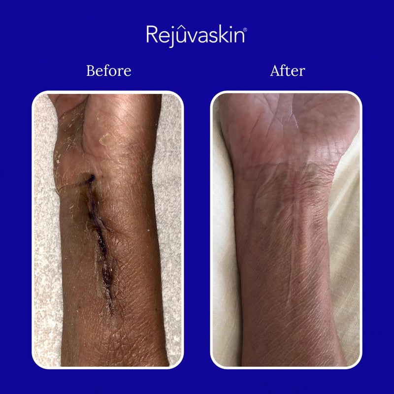 Rejuvaskin Scar Heal Kit for Small Scars, Soften, Flatten, Reduce and Recover, Silicone Sheeting, RejuvaSil Gel & Medical Tape, 1.5" x 3" - Image 5