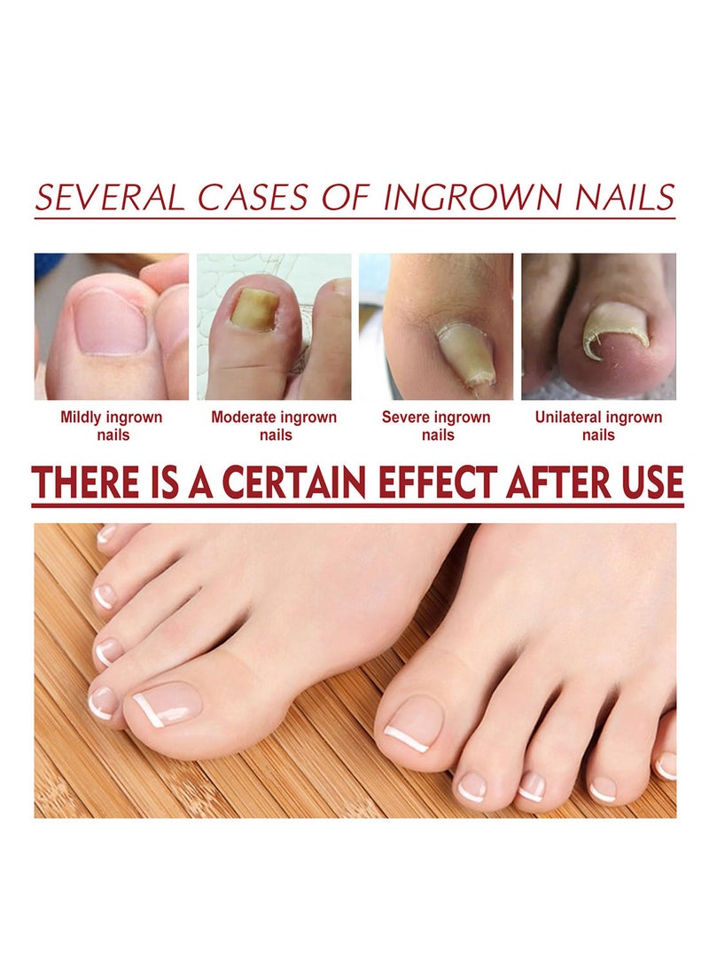 Jaysuing - Anti Paronychia Relief Oil Effective Best Nail Repair Solution Ingrown Toenail Treatment Pain Relief Oil for Damaged Thick and Discoloration Nail for Toenail Care - Image 1