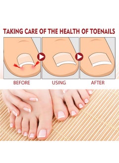 Jaysuing Anti Paronychia Relief Oil Effective Best Nail Repair Solution Ingrown Toenail Treatment Pain Relief Oil for Damaged Thick and Discoloration Nail for Toenail Care  - Image 5