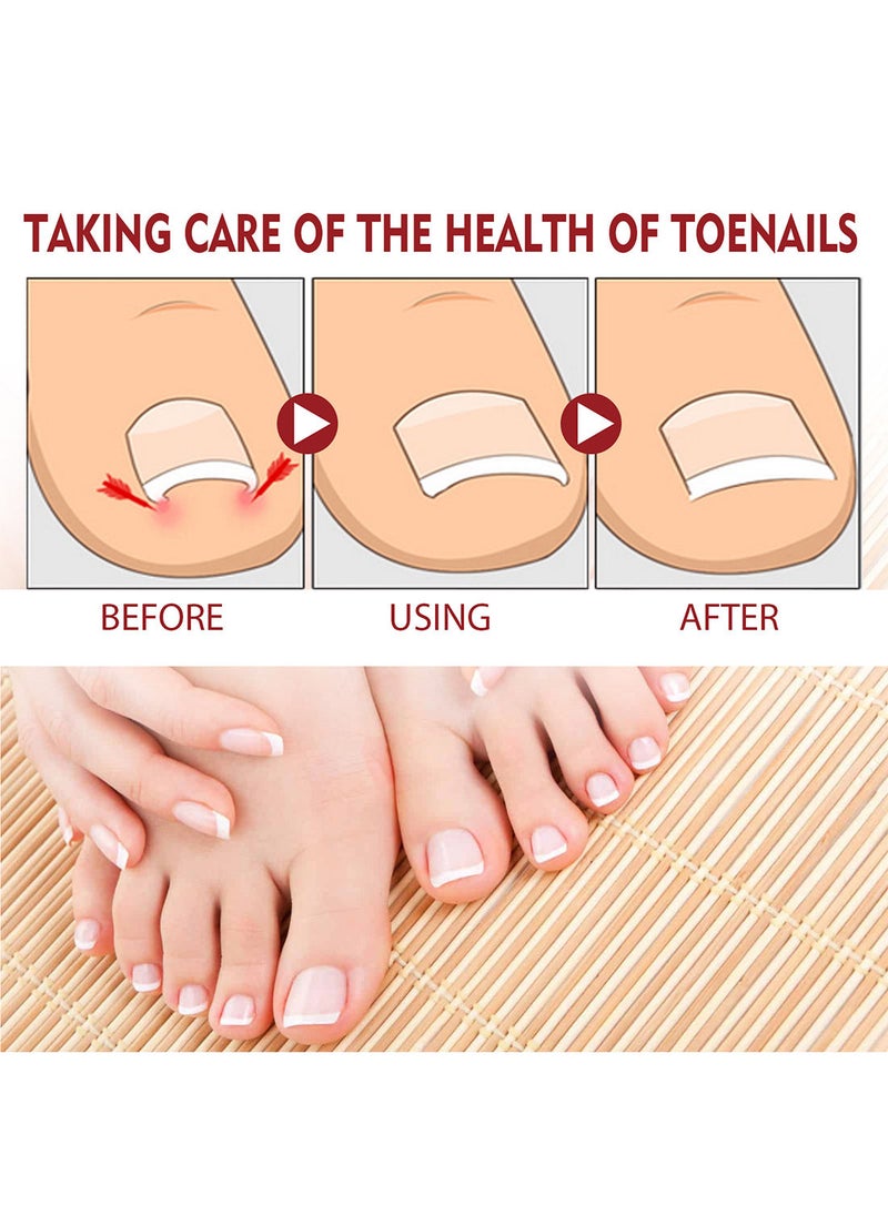 Jaysuing - Anti Paronychia Relief Oil Effective Best Nail Repair Solution Ingrown Toenail Treatment Pain Relief Oil for Damaged Thick and Discoloration Nail for Toenail Care - Image 1