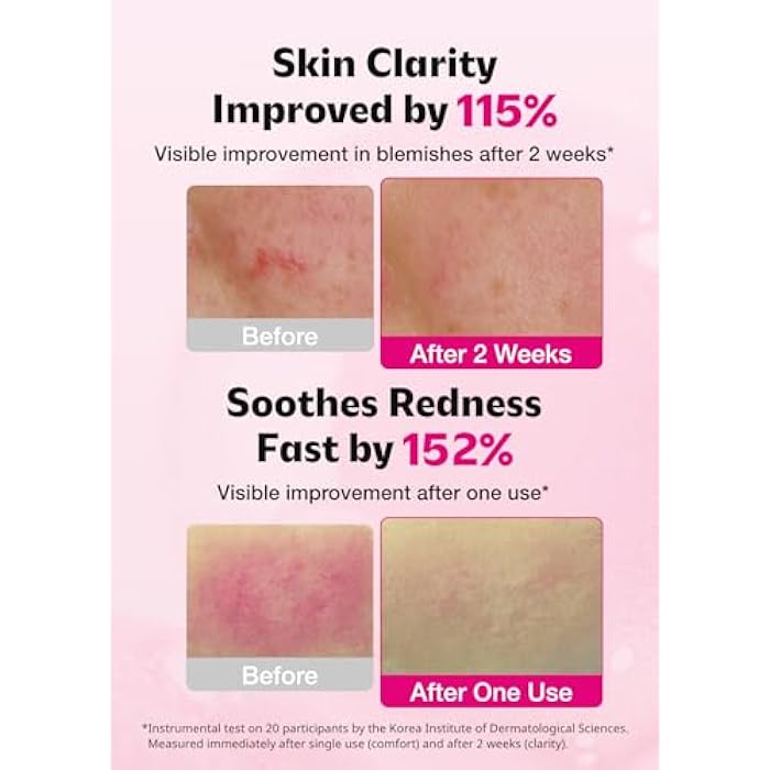 ISOI Blemish Care Up Serum for Face, Vegan Hydrating Serum for Smooth & Glass Skin Effect, Skin Barrier & Moisture Balance for Women, Arbutin & Rose Otto Oil, Korean Skin Care (0.85 fl. oz, 25ml) - Image 3