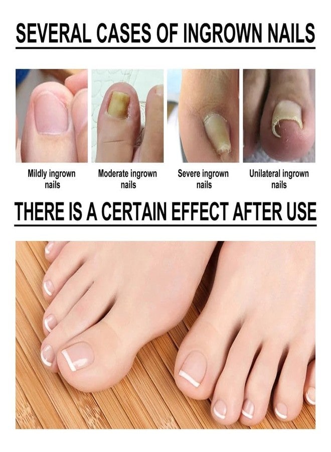 ROYALS RADIANCE Ingrown Toenail Softening & Care Drops | Nail Softener & Foot Hygiene Solution | Helps Reduce Discomfort, Prevents Inflammation, Disinfects & Supports Nail Health 50Ml x Pack 1 - Image 4
