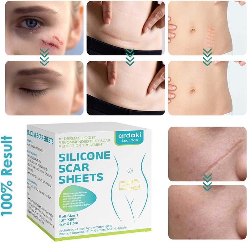 ARDAKI Silicone Scar SheetsSilicone Scar TapeScar Tape for Surgical ScarsSilicone Scar Removal for SurgicalCSectionTummy TuckKeloid Scars Face Tape Keloid Bump Removal 16X 60 Roll15M - Image 2