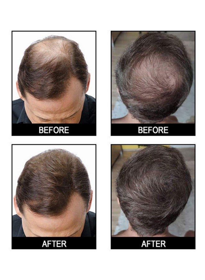 gowwim Hair Fibers for Thinning Hair 25g Hair Building Fibers 100% Undetectable,Instantly Cover Sparse Hair Areas-Bald Spots Cover Up. (Dark Brown) - Image 3