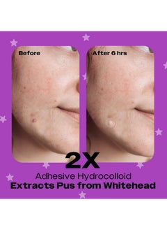 AVARELLE AVARELLE Spot Pimple Patches for Face | ZitOut Good Night Acne Patches | FSA HSA Acne Treatment Hydrocolloid Acne Patches | Hydrocolloid Bandages for Acne with Tea Tree Oil | Acne Spot Treatment  - Image 3