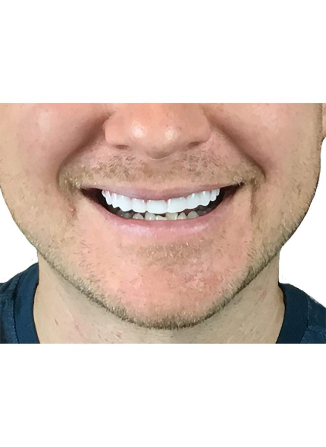 Flex 2Pk - Bright White Shade - One Size Fits Most. Fix Your Smile At Home In Minutes! Comfortable Upper Cosmetic Veneer For A Perfect Smile!