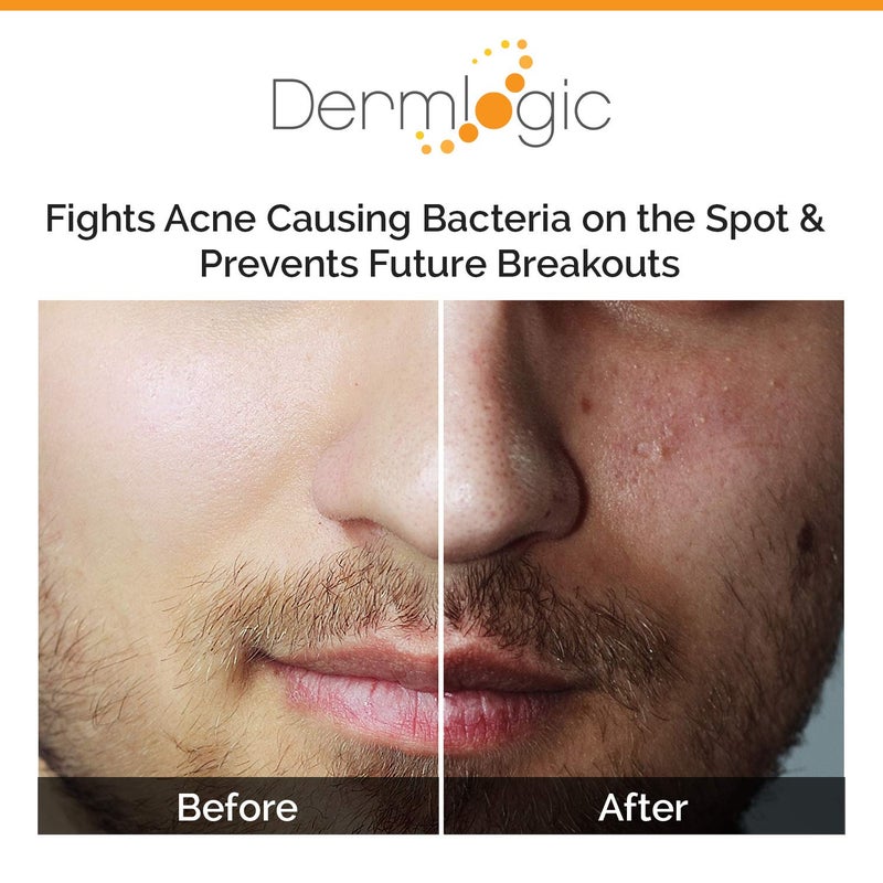Dermlogic Acne Spot Treatment- Overnight Treatment for Whitehead & Blackhead Pimples. Eliminate Cystic Breakouts & Clogged Pores. Clears Away Severe, Mild, Moderate Blemishes for Teens & Adults. Alcohol-Free. - Image 4